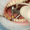 Implantul dentar si increderea in sine